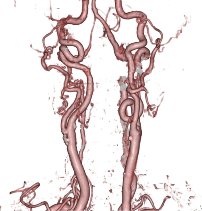 図4．頸部CT Angiography