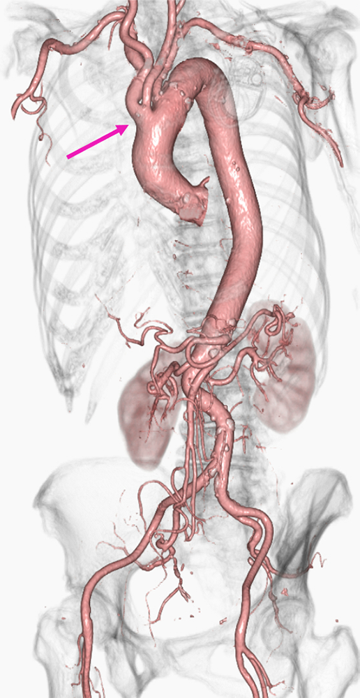 図5．胸腹部CT Angiography