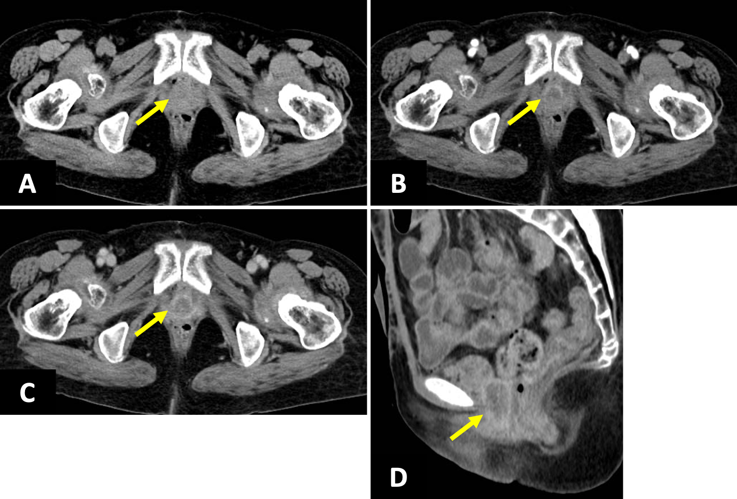 図1．腹部造影CT（A：単純、B：動脈相、CおよびD：遅延相）
