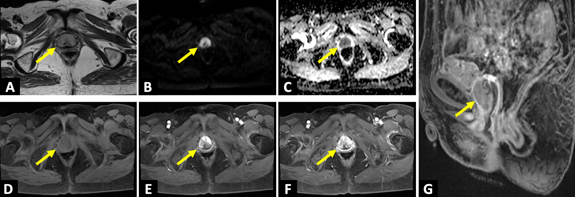 図2．ガドビスト造影MRI（A：T2強調像像、B：拡散強調像、C：ADC map、D：造影前、E：40秒後、F：80秒後、G：遅延相）