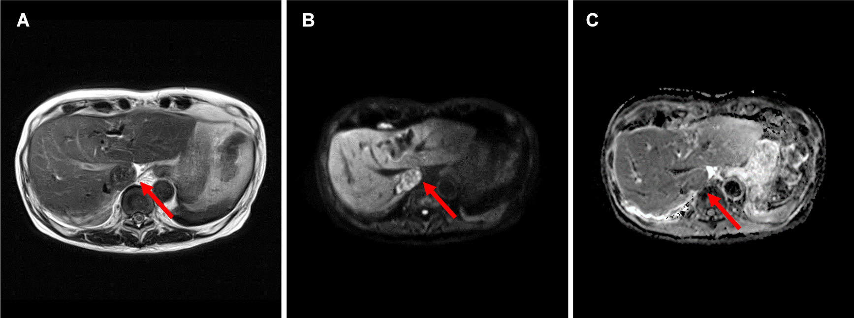 図2．ガドビスト造影MRI （A:T2WI B:DWI(b=800) C:ADCmap D:造影前脂肪抑制T1WI E:造影後脂肪抑制T1WI F:造影後True FISP G:造影後TrueFISP冠状断像）