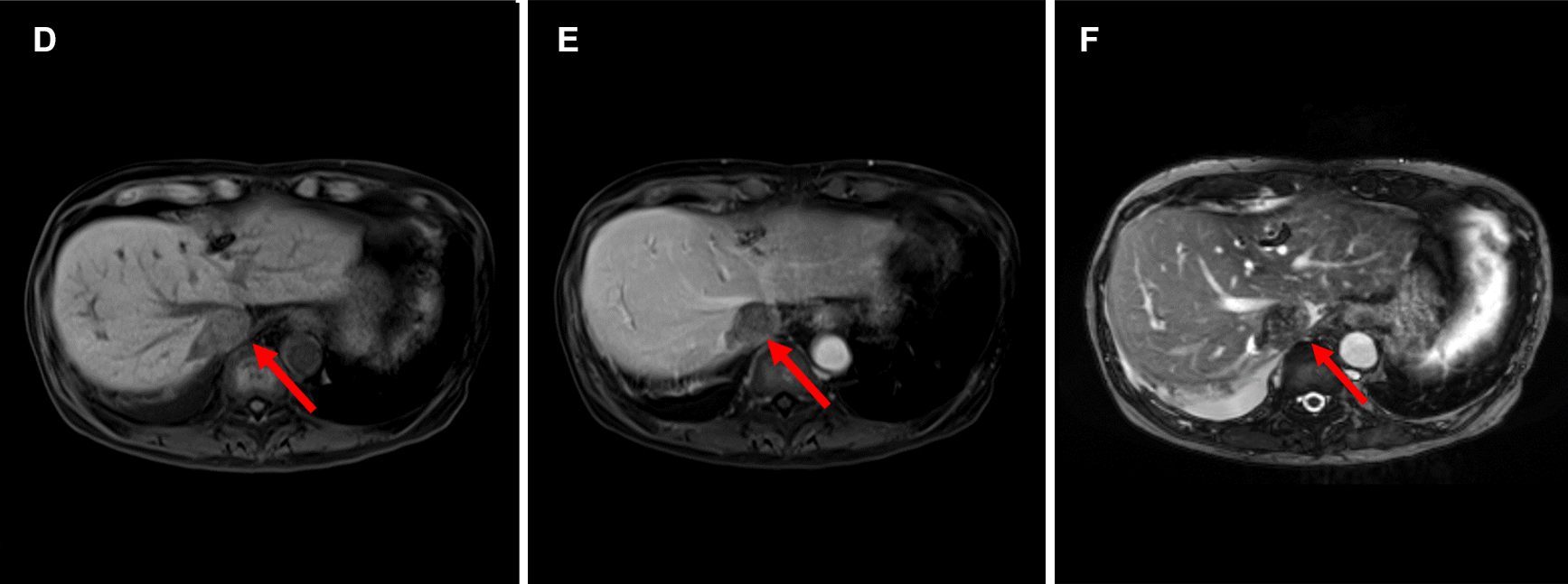 図2．ガドビスト造影MRI （A:T2WI B:DWI(b=800) C:ADCmap D:造影前脂肪抑制T1WI E:造影後脂肪抑制T1WI F:造影後True FISP G:造影後TrueFISP冠状断像）