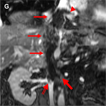 図2．ガドビスト造影MRI （A:T2WI B:DWI(b=800) C:ADCmap D:造影前脂肪抑制T1WI E:造影後脂肪抑制T1WI F:造影後True FISP G:造影後TrueFISP冠状断像）