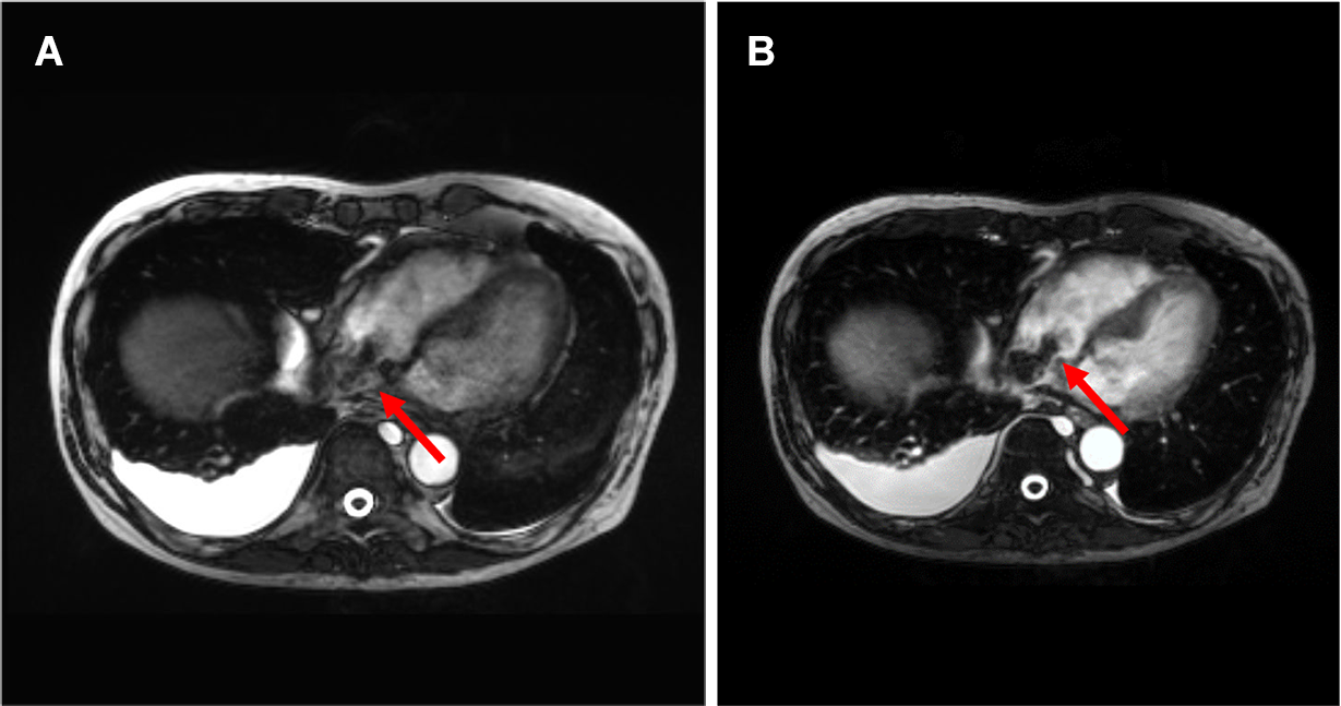 図3．ガドビスト造影MRI（右房レベル）（A:単純True FISP B:造影TrueF ISP）