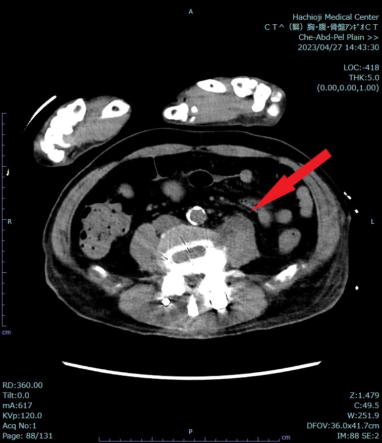 図1．単純(120keV)
