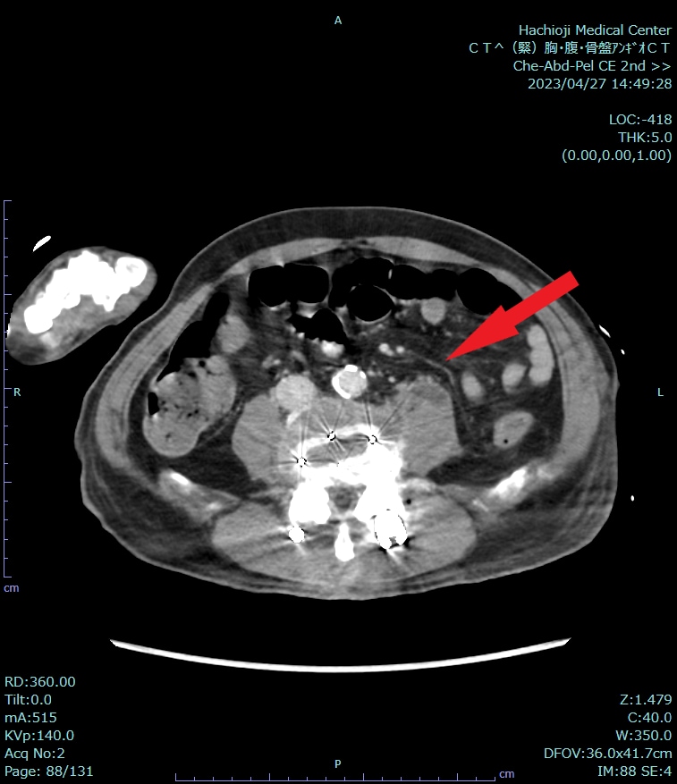 図2．静脈相(120keV)