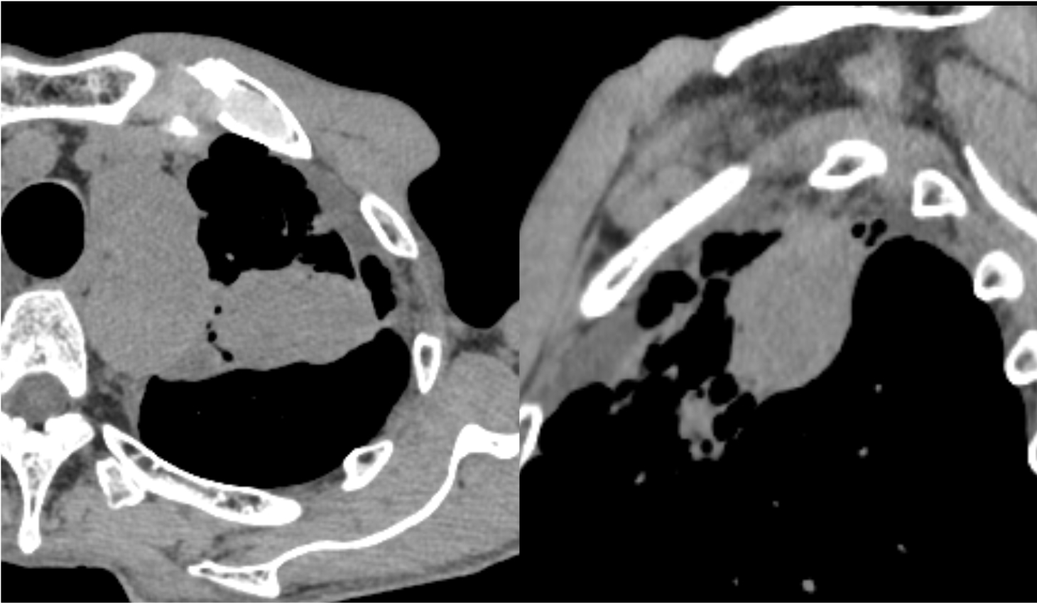 図1．単純CT縦隔条件