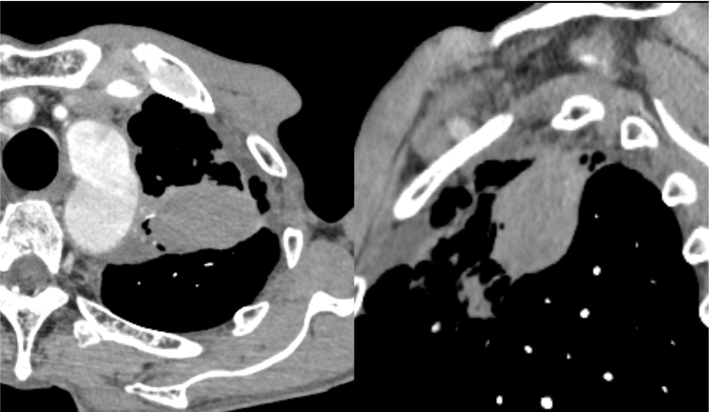 図2．造影CT早期相