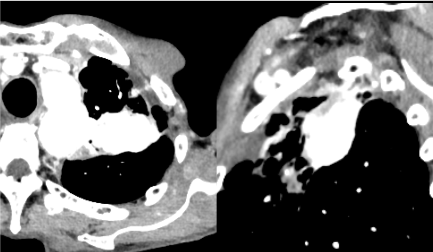 図3．造影CT後期相（Virtual Monoenergetic Image 40keV表示）