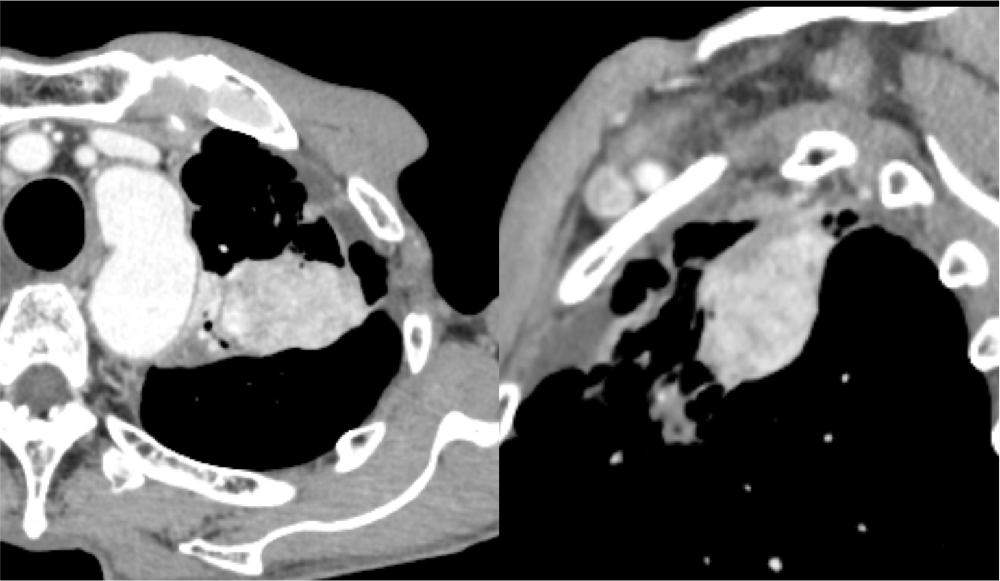 図4．造影CT後期相（Virtual Monoenergetic Image 70keV表示）