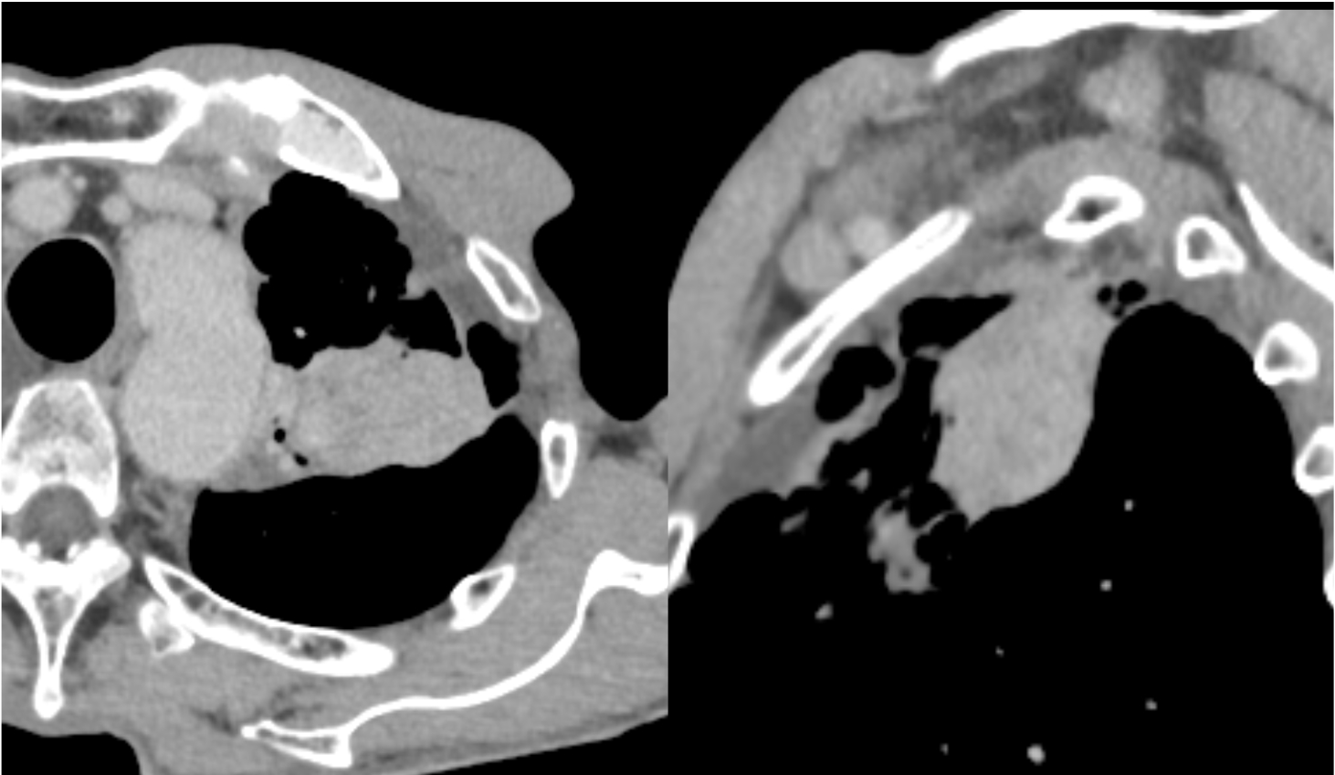 図5．造影CT後期相（Virtual Monoenergetic Image 100keV表示）