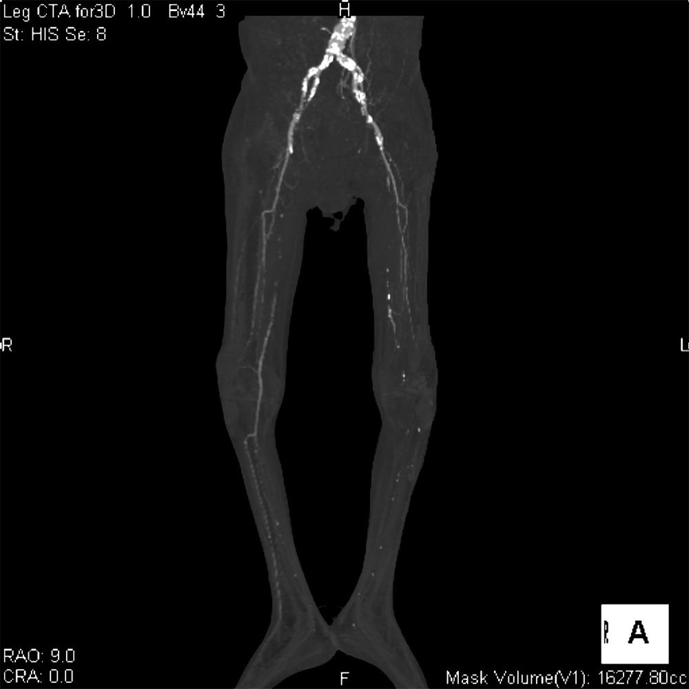 図1．MIP(maximum intensity projection)像、両下肢