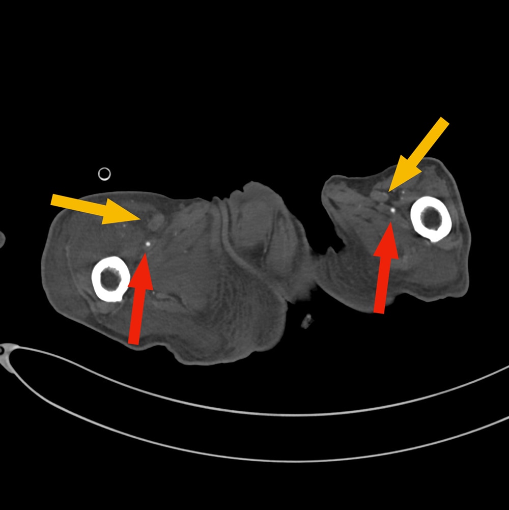 図2．浅大腿動脈レベル、横断像、動脈相