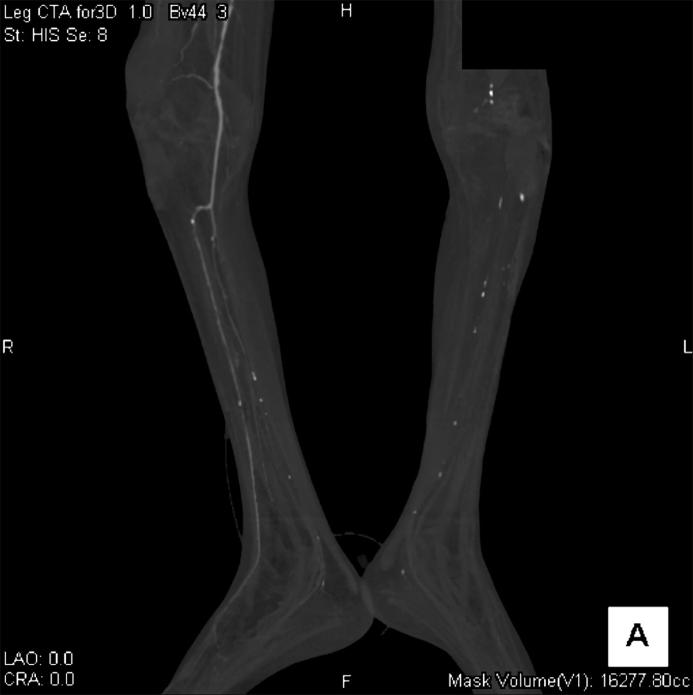 図3．MIP(maximum intensity projection)像、両下腿