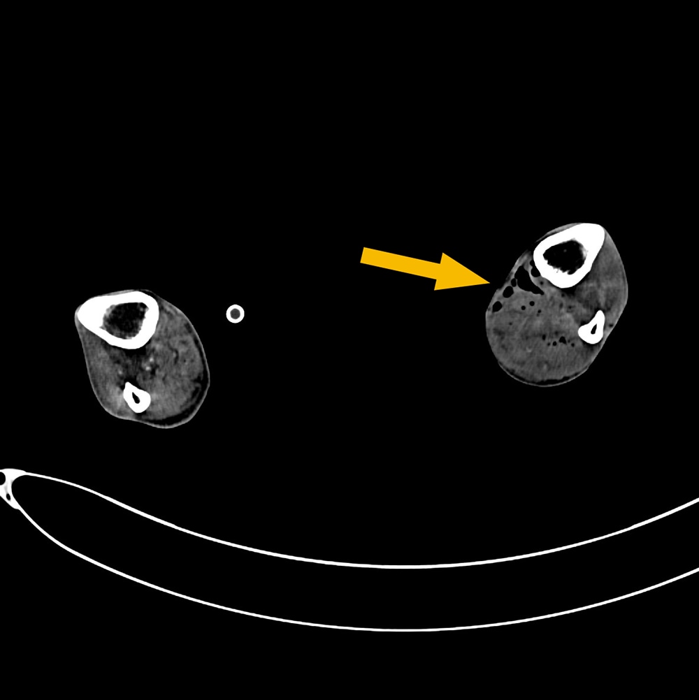 図4．下腿三枝レベル、横断像、動脈相