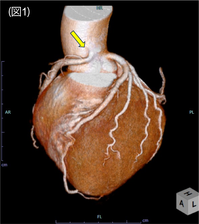 図1．冠動脈CT　volume rendering像