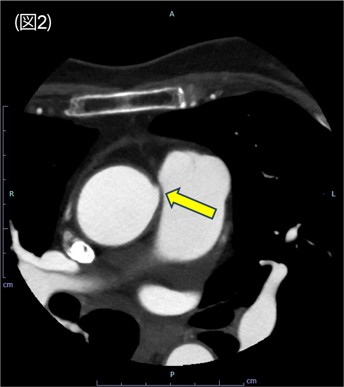 図2．冠動脈CT　axial 像