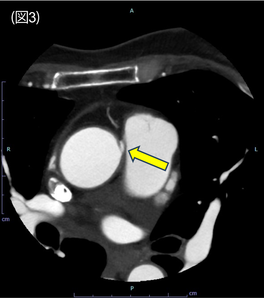 図3．冠動脈CT　axial 像