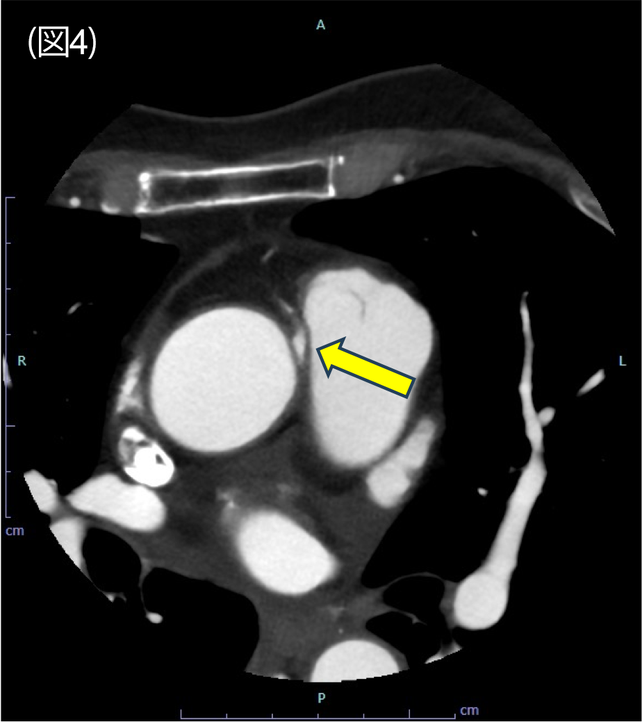 図4．冠動脈CT　axial 像