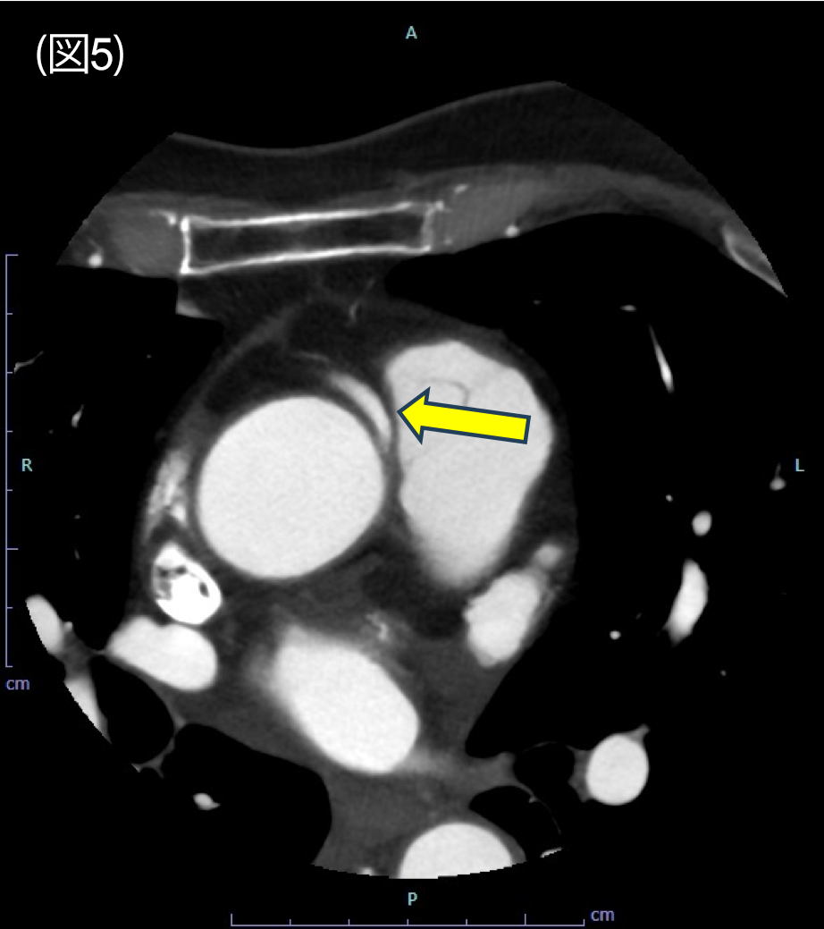 図5．冠動脈CT　axial 像
