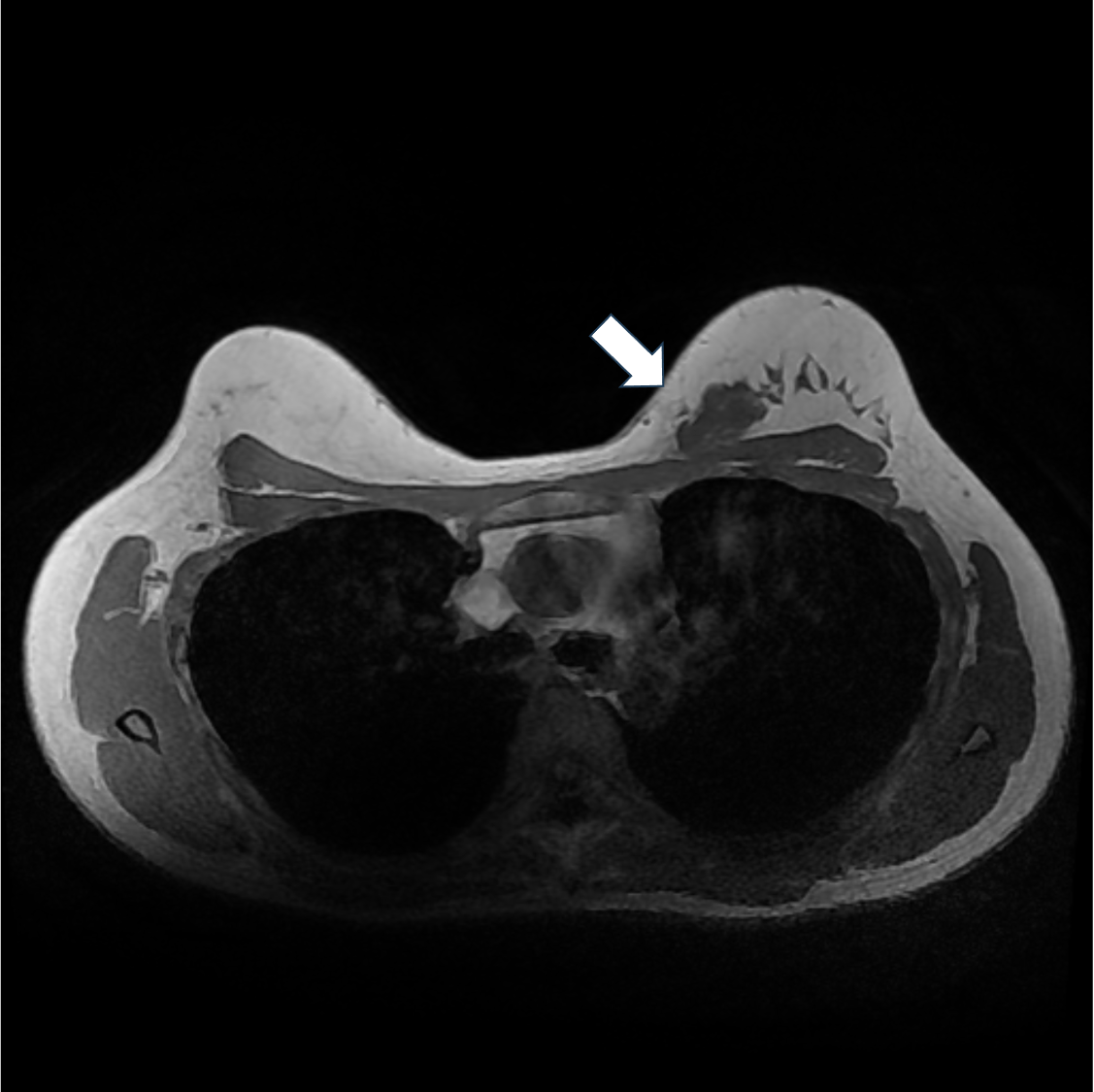 1. T1強調画像（造影前）