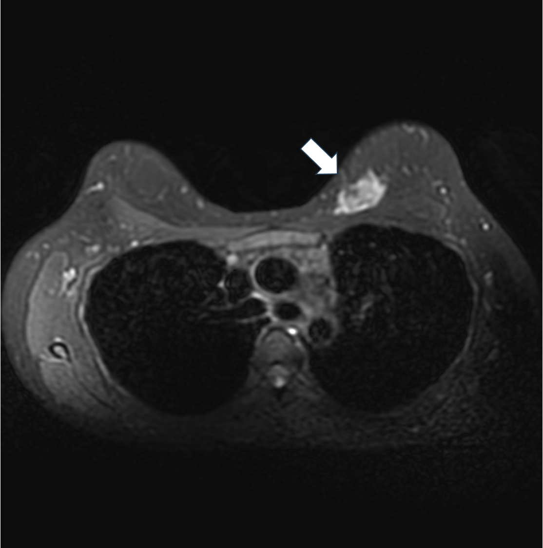 2. 脂肪抑制T2強調画像（造影前）