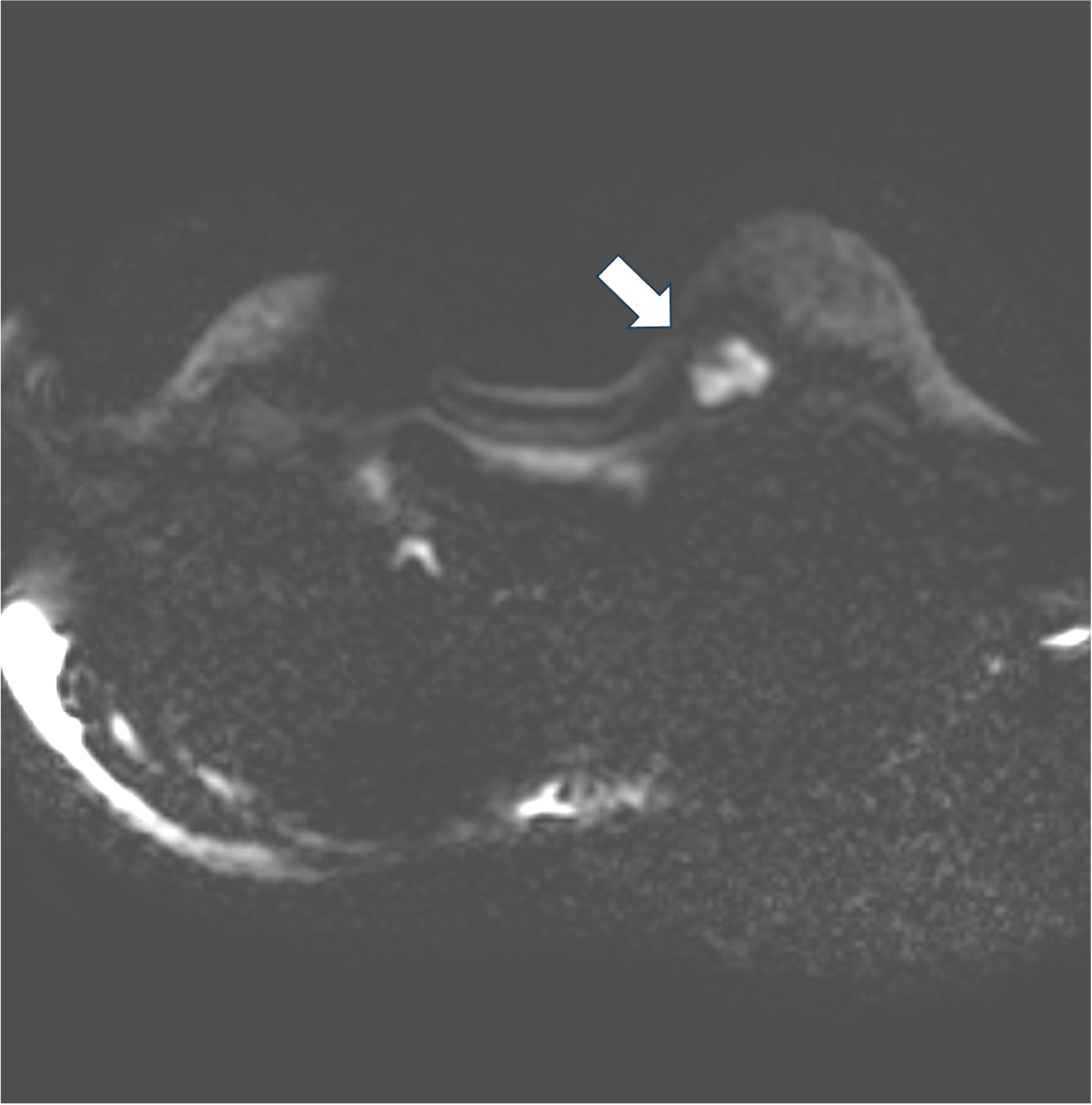 3. 拡散強調画像　b=1000(s/mm2)（造影前）
