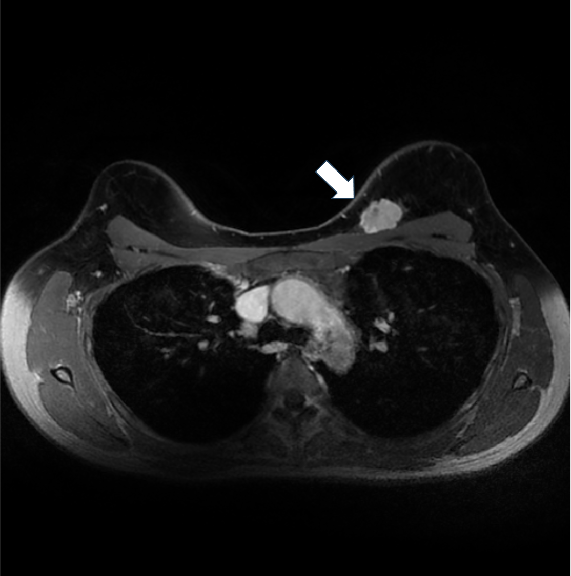 5. ダイナミックMRI 早期相