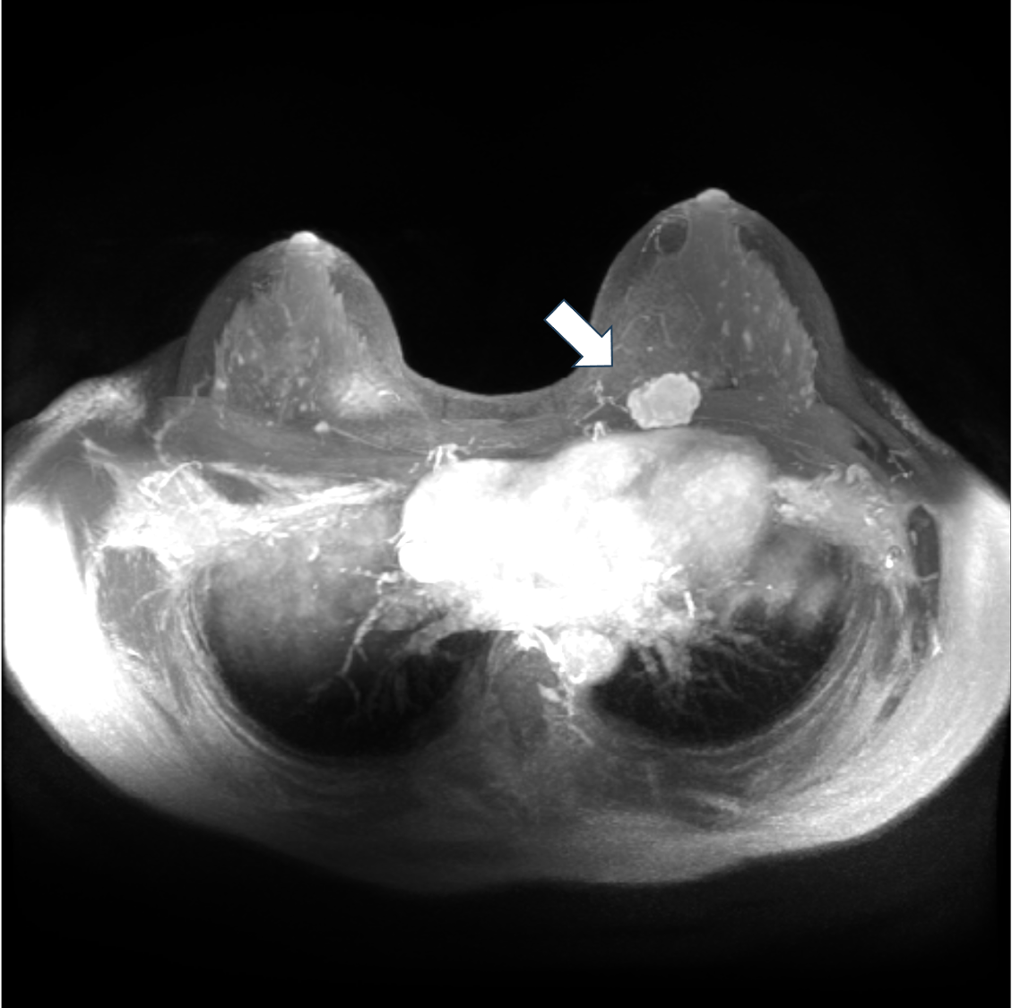 6. ダイナミックMRI　早期相 MIP像
