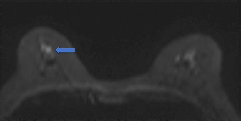 1. 拡散強調画像、ADCmap