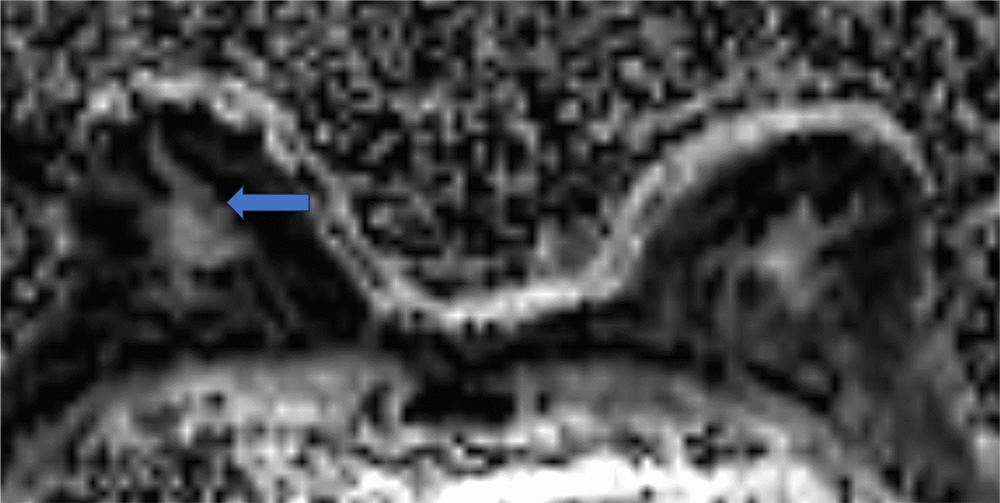 1. 拡散強調画像、ADCmap