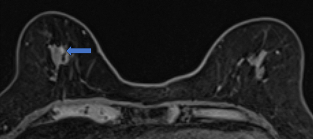4. ダイナミックMRI 造影前 早期相 遅延相
