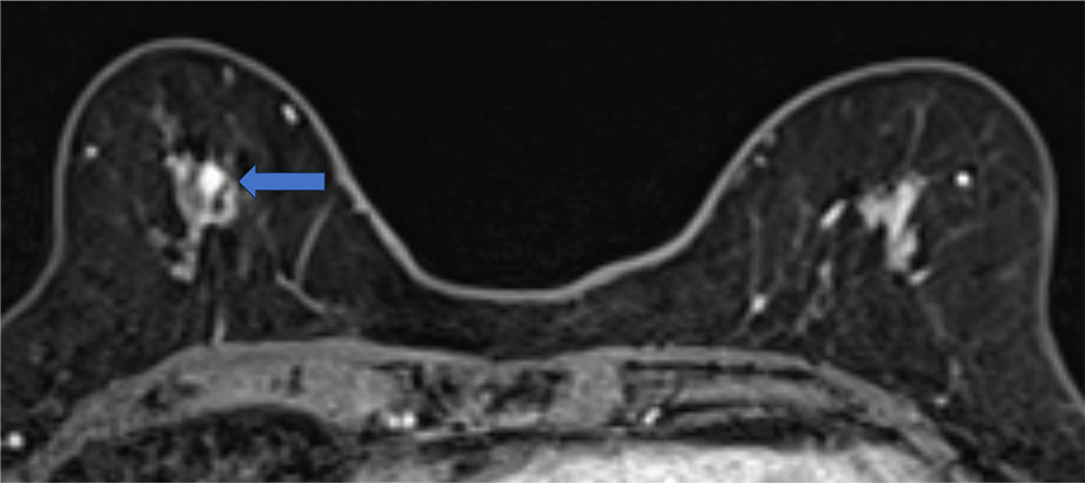 ダイナミックMRI 早期相