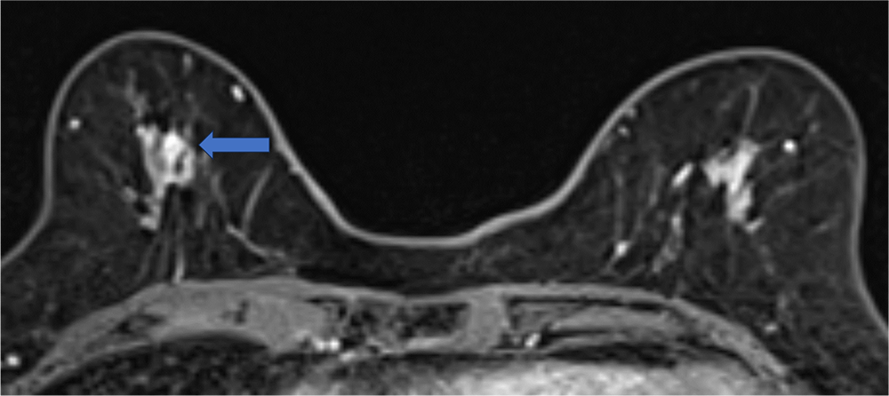 ダイナミックMRI 遅延相