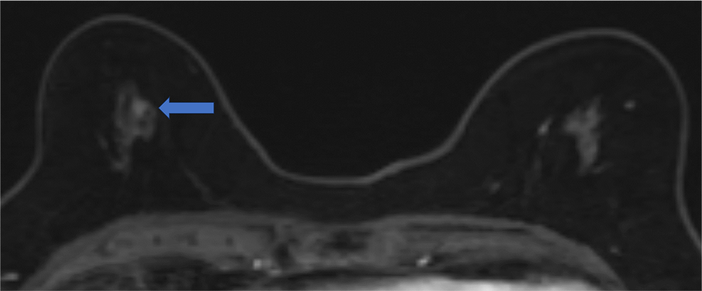 5. Ultrafast DCE　（20相目、造影剤投与開始から58秒後）