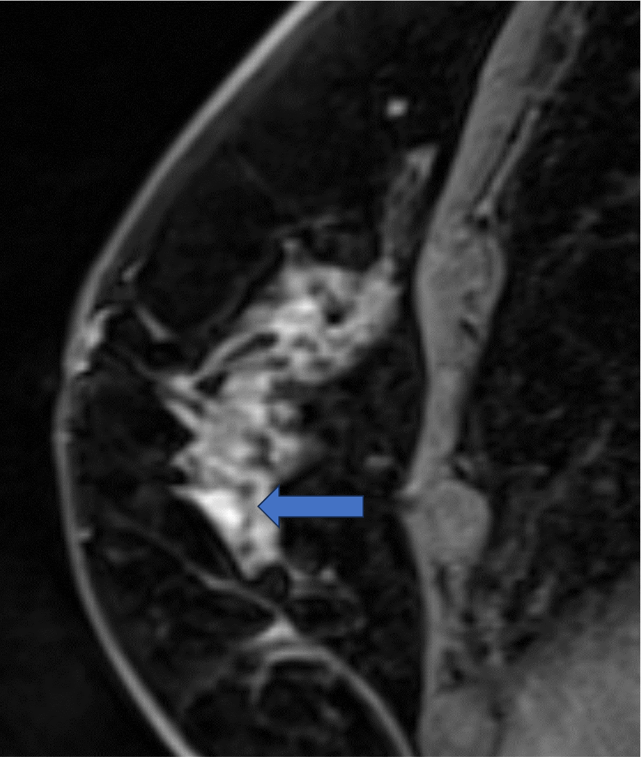 6. 造影後高分解能画像