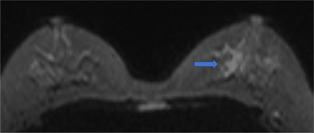 1. 拡散強調画像、ADCmap