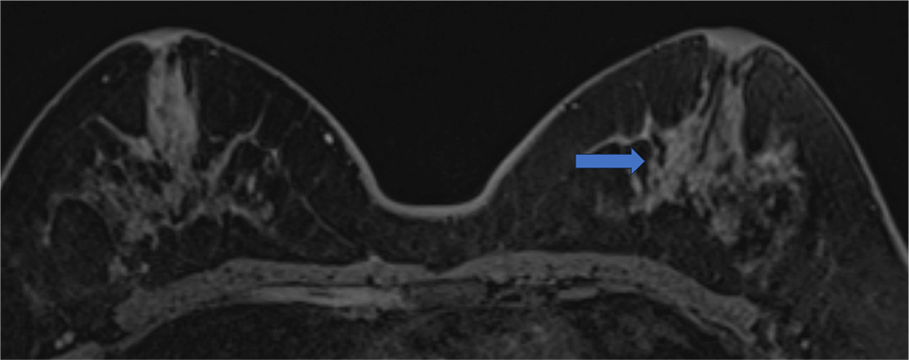 4. ダイナミックMRI 造影前 早期相 遅延相