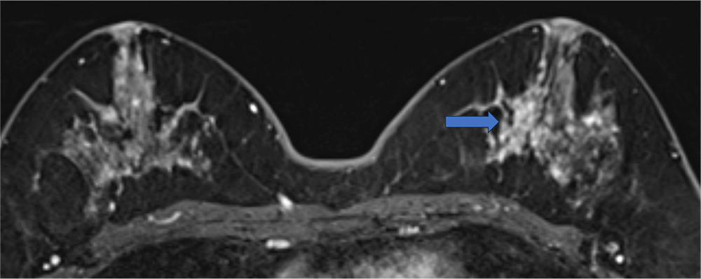 ダイナミックMRI 早期相