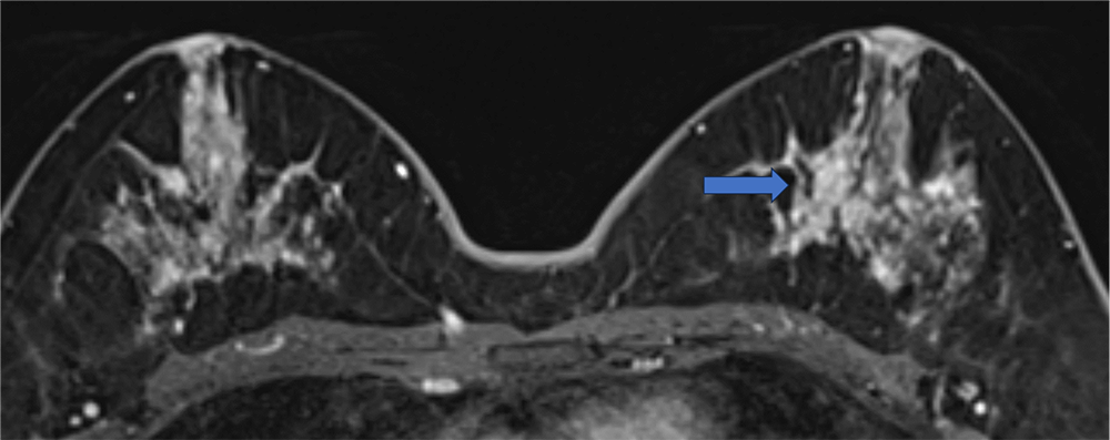 ダイナミックMRI 遅延相