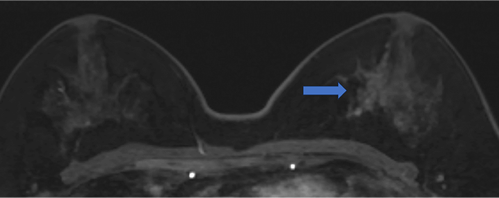 5. Ultrafast DCE　造影剤投与約20秒後、23秒後、26秒後