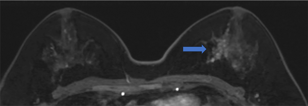 ultrafast MRI 造影剤投与約23秒後