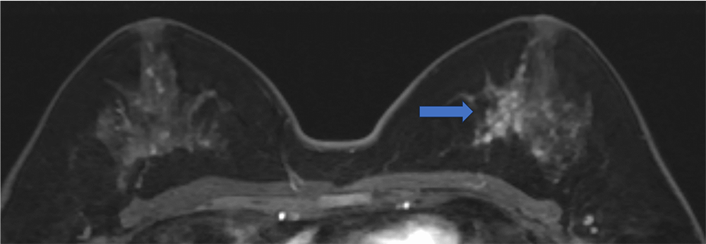ultrafast MRI 造影剤投与約26秒後