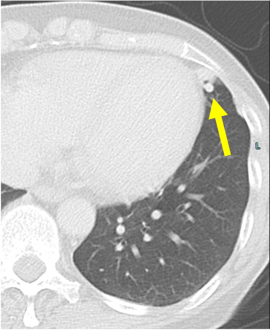 図１．非造影CT　肺野条件