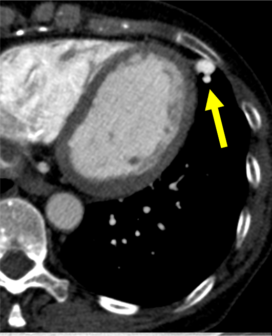 図2．肺動脈相　水平断