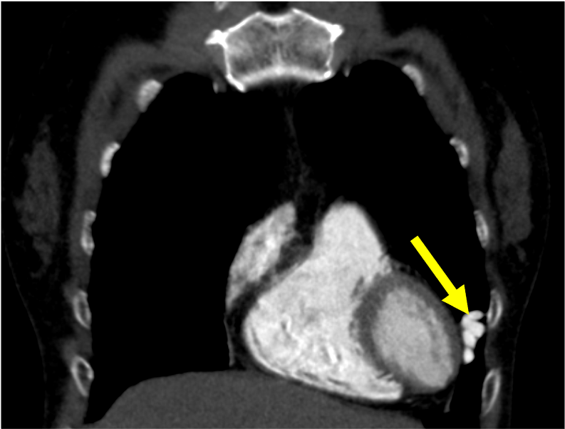 図3．肺動脈相　冠状断