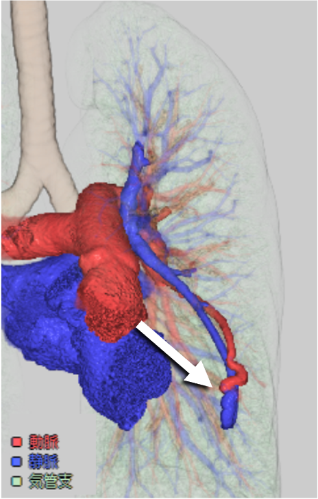 図4．肺動脈相　ボリュームレンダリング画像