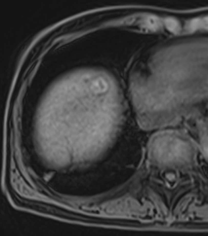 図3．単純脂肪抑制T1WI