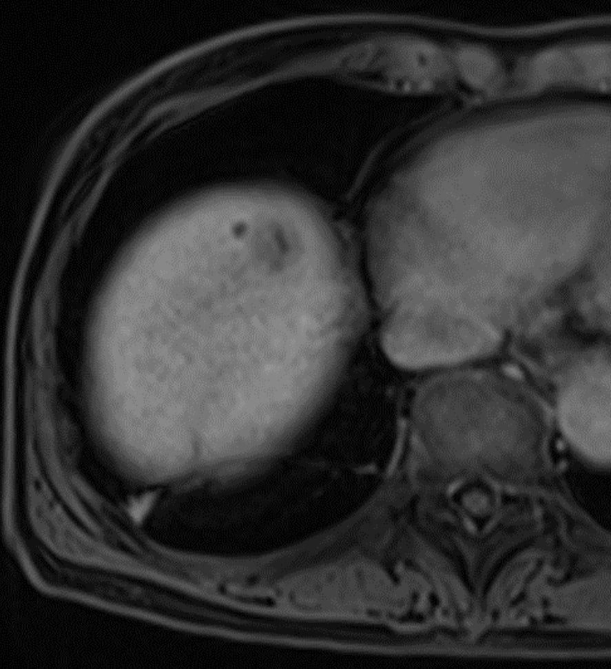 図4．造影T1WI後期相