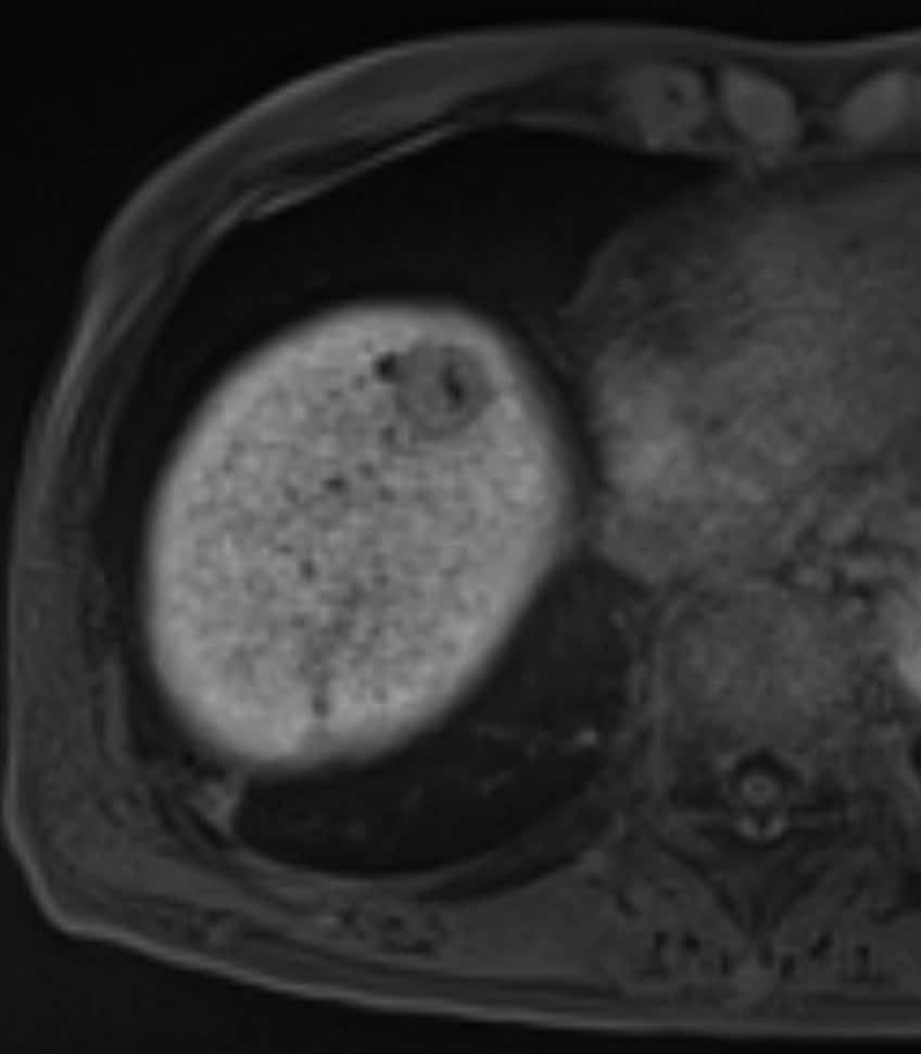 図5．造影T1WI肝細胞相